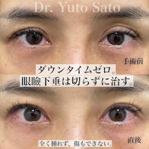 【40代女性・目元】切らない眼瞼下垂プレミアム_before_aftar
