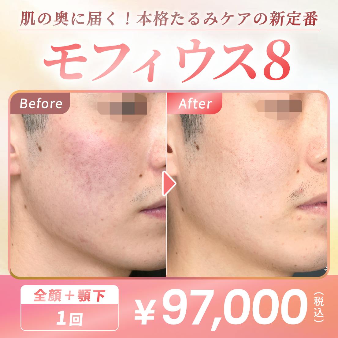 ❣️キレイレポおすすめ❣️ モフィウス8 | マイクロニードル x RF(高周波)で圧倒的なタイトニング🥰のサムネイル