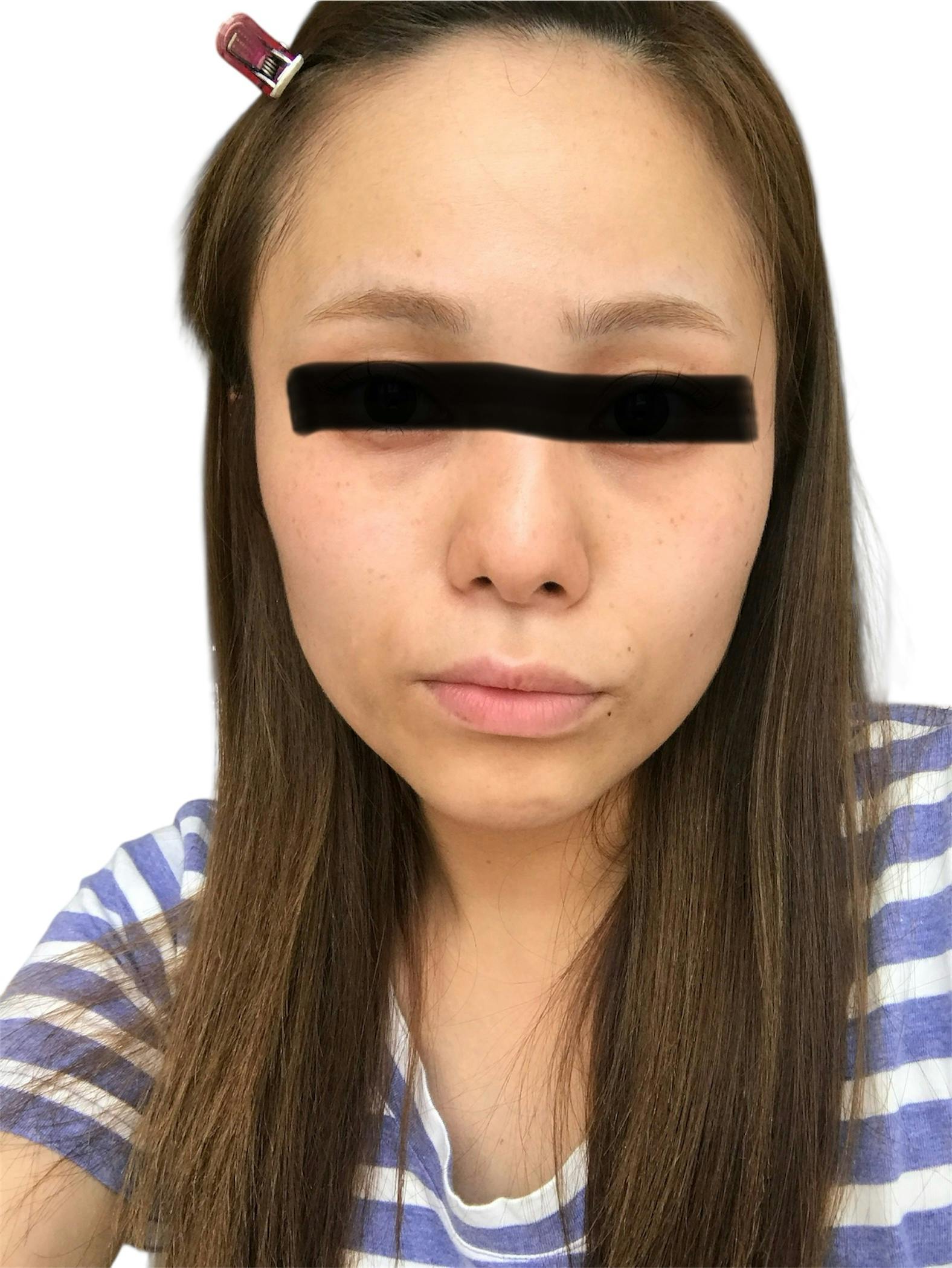 湘南美容クリニック 札幌院で糸リフト(スレッドリフト)・糸リフト(スレッドリフト)を受けたりりさんの写真