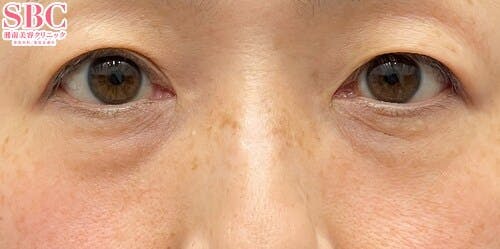 【女性・クマ】目の下の切らないクマ・たるみ（ふくらみ）取り ナチュラル脂肪注射コンデンスリッチ ナチュラル脂肪注射ナノリッチ_before