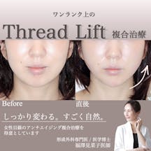 【女性・輪郭】糸リフト、ヒアルロン酸、ボトックス_before_aftar