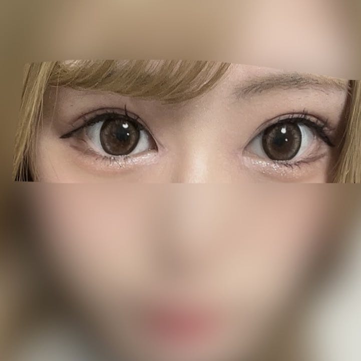 TCB東京中央美容外科 福岡天神院で二重整形・二重埋没・目頭・蒙古ひだ切開を受けたみゃんさんの写真