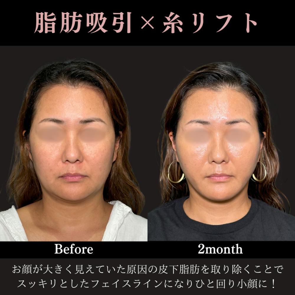 【40代女性・顔】脂肪吸引プレミアム（頬・顎下）+ 糸リフト_before_aftar