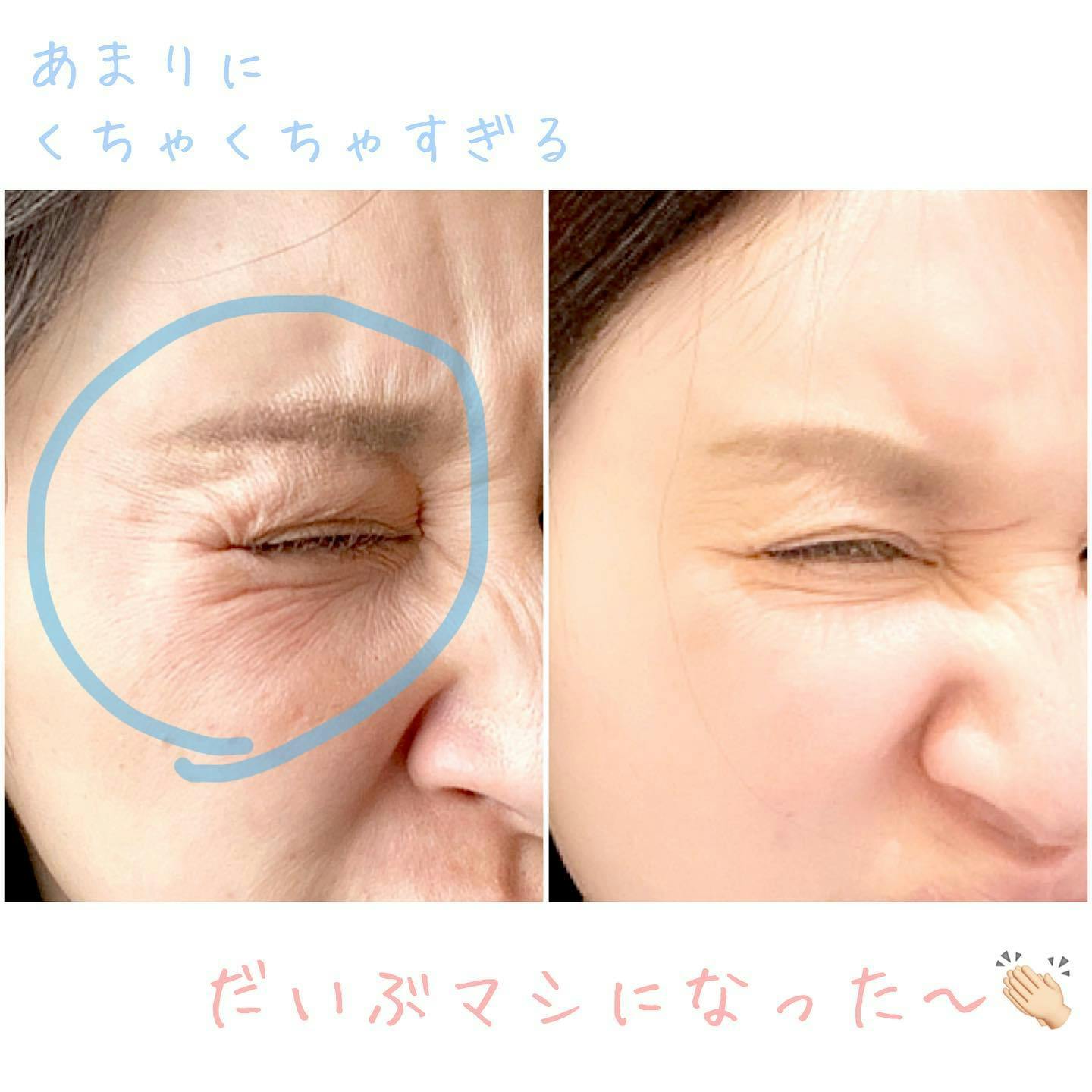 【女性・シワ】ボトックス（目元）_before_aftar