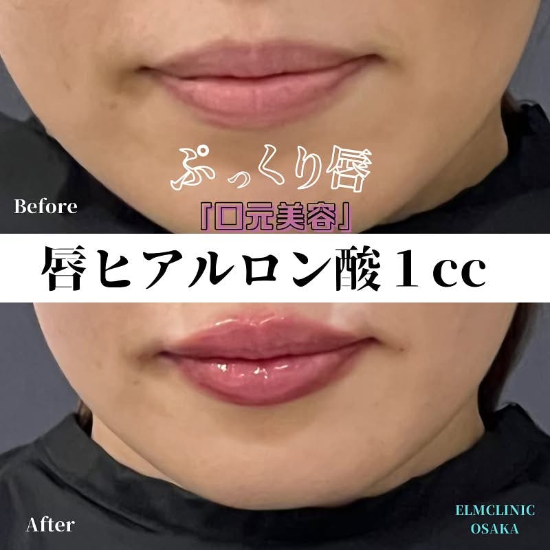 【女性・唇】ヒアルロン酸_before_aftar