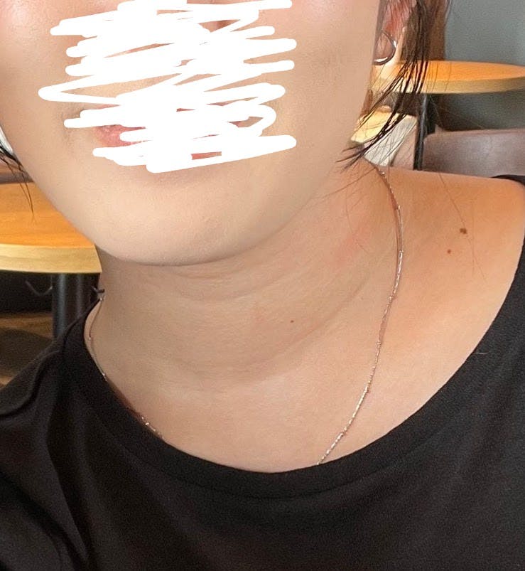 BAO(バオ)クリニック 神戸院でインモードリフティングを受けたむぎちゃんさんの写真