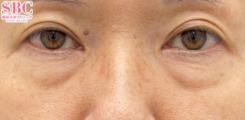 【50代女性・目元】アイバックリムーブ法、ナチュラル脂肪注射コンデンスリッチ、ナチュラル脂肪注射ナノリッチ_before