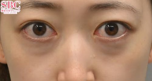 【20代女性・目元】目の下の切らないクマ・たるみ（ふくらみ）取り ナチュラル脂肪注射コンデンスリッチ ナチュラル脂肪注射ナノリッチ_before