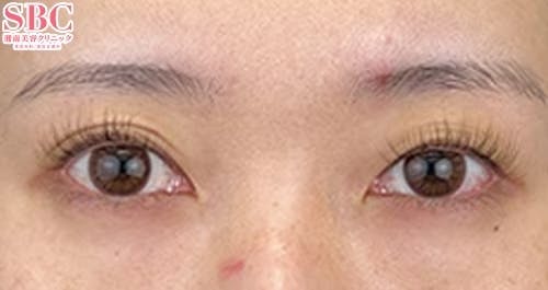 【20代女性・目元】線留めクロス二重術_before