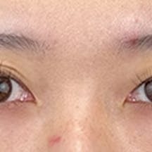 【20代女性・目元】線留めクロス二重術_before