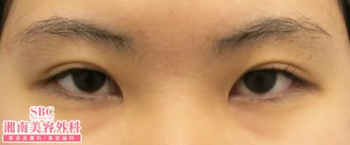 【女性・目元】クイックコスメティーク・ダブルNeo・クイックコスメティーク・シングルNeo・目頭切開プレミアム_before