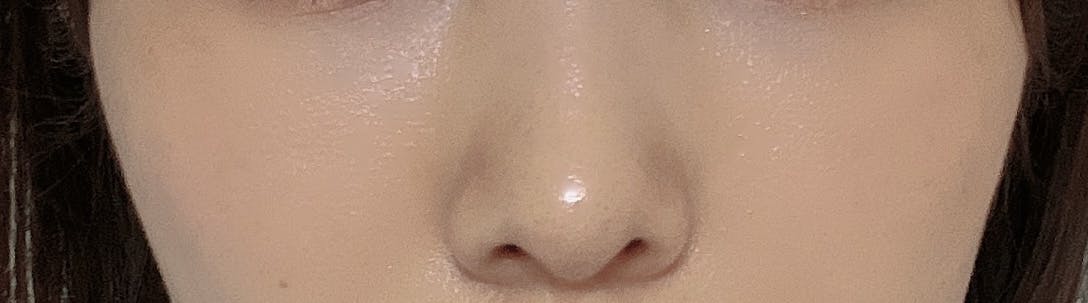 ブリンククリニック(BLINC CLINIC)で目の下のクマ脂肪注入を受けたりりさんの写真