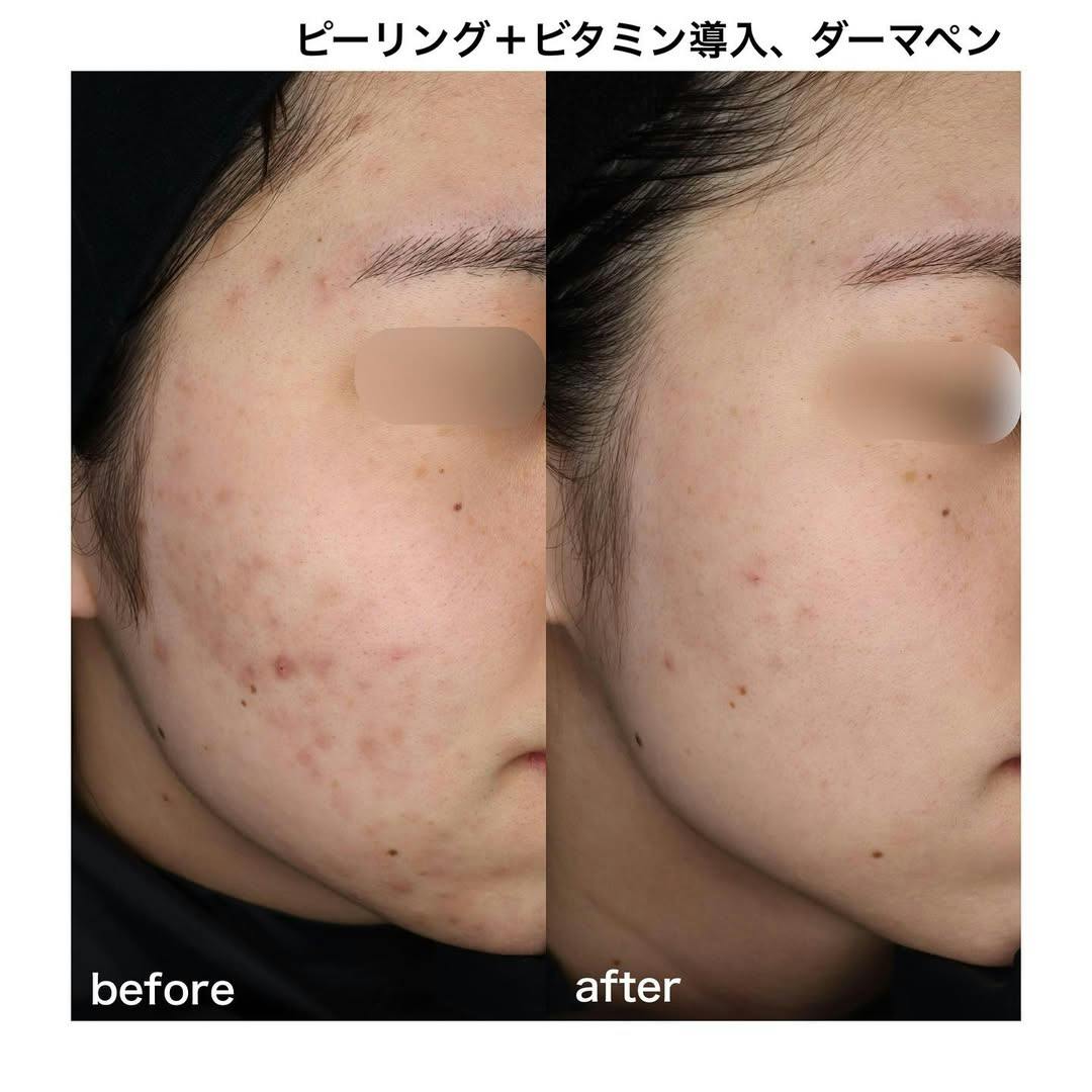 【女性・顔】ケミカルピーリング＋ビタミン導入＋ダーマペン4(BENEVグロスファクター有)_before_aftar