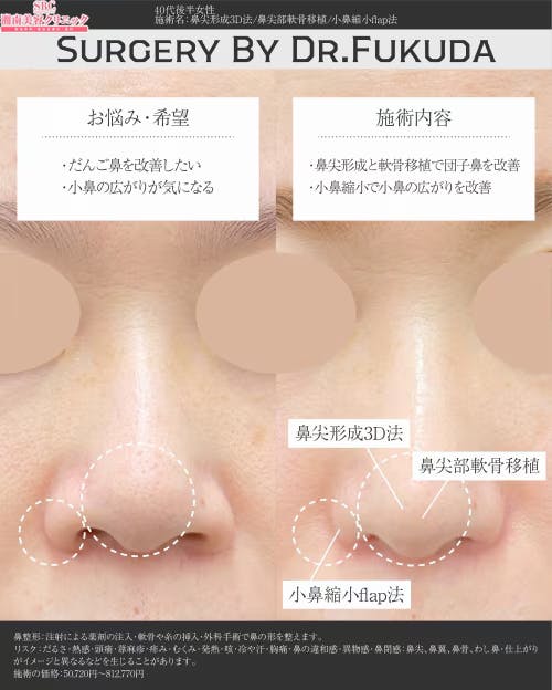 【40代女性・鼻】鼻尖形成3D法、鼻尖部軟骨移植、小鼻縮小flap法_before_aftar