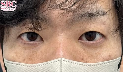 【30代男性・目元】目の下の切らないクマ・たるみ（ふくらみ）取り、ナチュラル脂肪注射_aftar