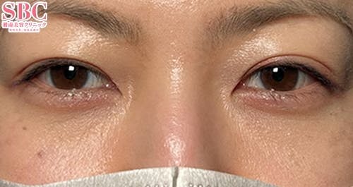 【女性・目元】リジュランHB_before