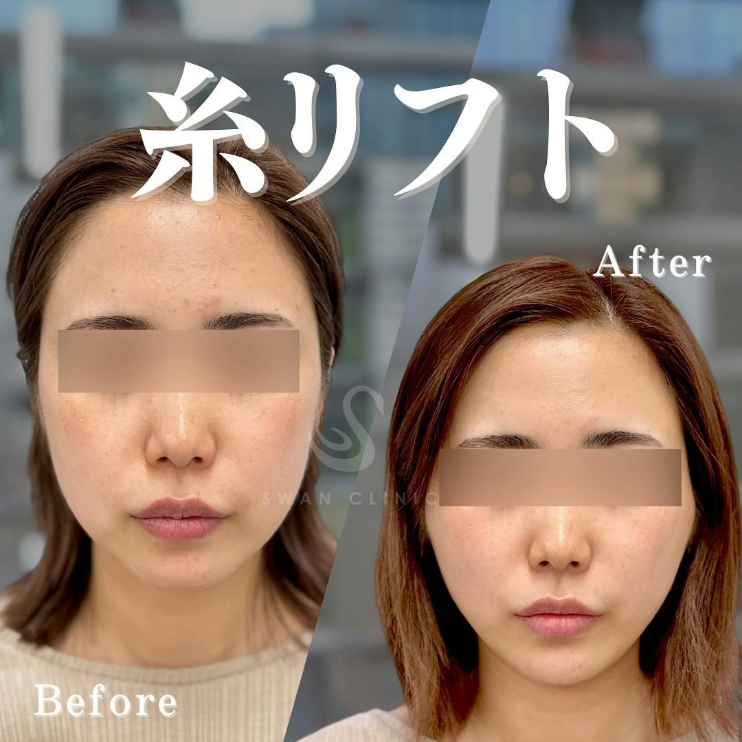 【女性・輪郭】糸リフト_before_aftar