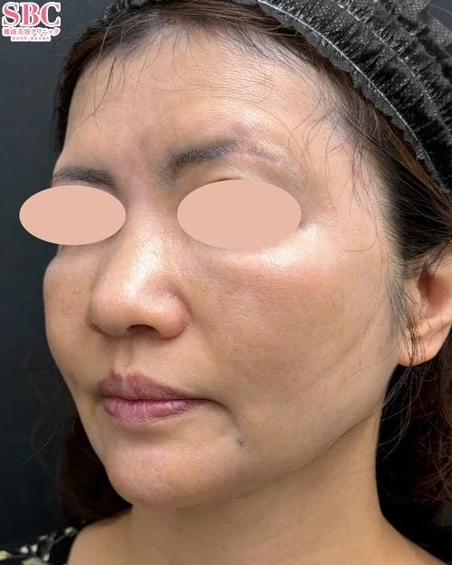 【女性・たるみ】メーラーファット除去術_aftar