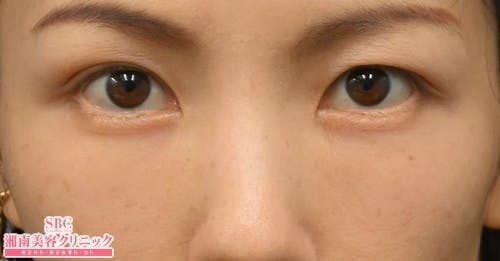 【女性・目元】目の下の切らないクマ・たるみ（ふくらみ）取り ナチュラル脂肪注射コンデンスリッチ ナチュラル脂肪注射ナノリッチ_after