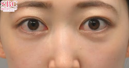 【20代女性・目元】目の下の切らないクマ・たるみ（ふくらみ）取り ナチュラル脂肪注射コンデンスリッチ ナチュラル脂肪注射ナノリッチ_after