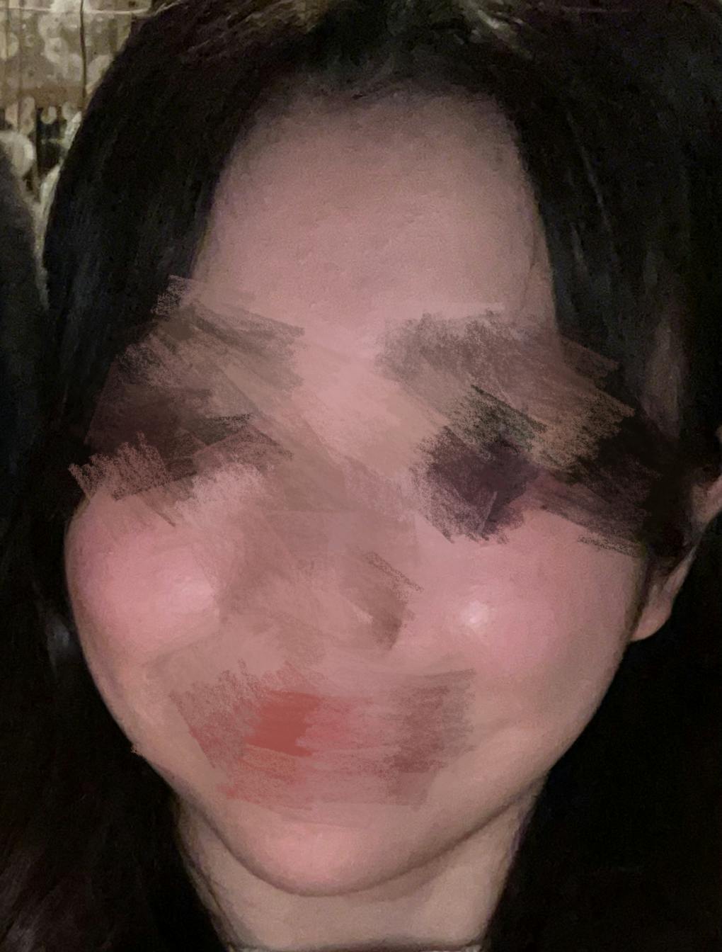 おおかみ美容のクリニック 新宿本院でマッサージピールを受けたまいさんの写真