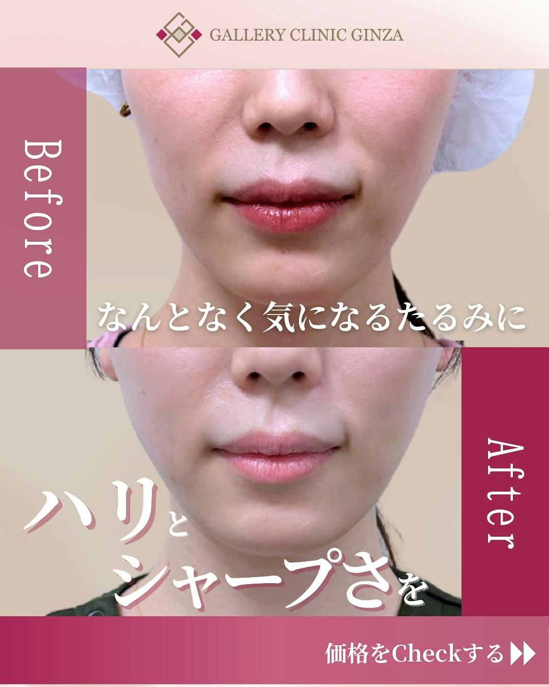 【女性・たるみ】アルテミスリフト_before_aftar