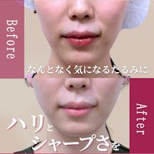 【女性・たるみ】アルテミスリフト_before_aftar