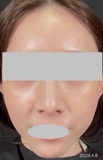 Casa de GRACIA GINZA(カサ・デ・グラシア銀座)でマッサージピール(コラーゲンピール)を受けたarai03さんの写真