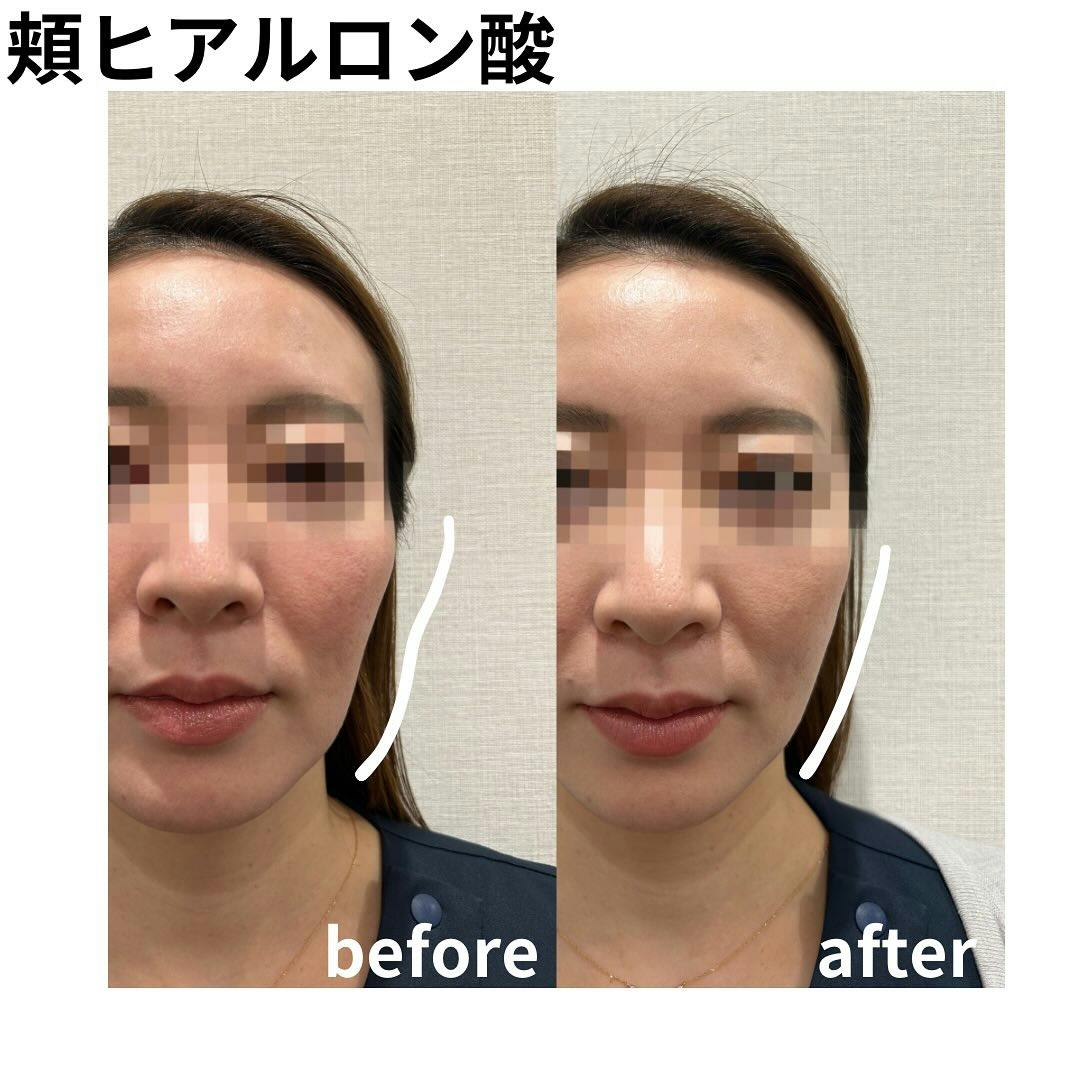 【女性・頬】ヒアルロン酸_before_aftar