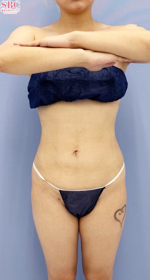 【女性・腹部】Aquicell（アキーセル）脂肪吸引、根こそぎVASER脂肪吸引_aftar