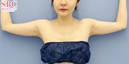 【女性・二の腕】Aquicell（アキーセル）脂肪吸引、根こそぎVASER脂肪吸引_before