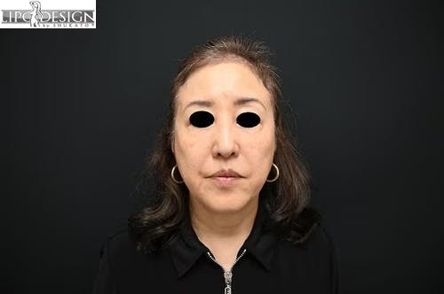 【64歳女性・口元】SBCプレミアムPRP皮膚再生療法_after