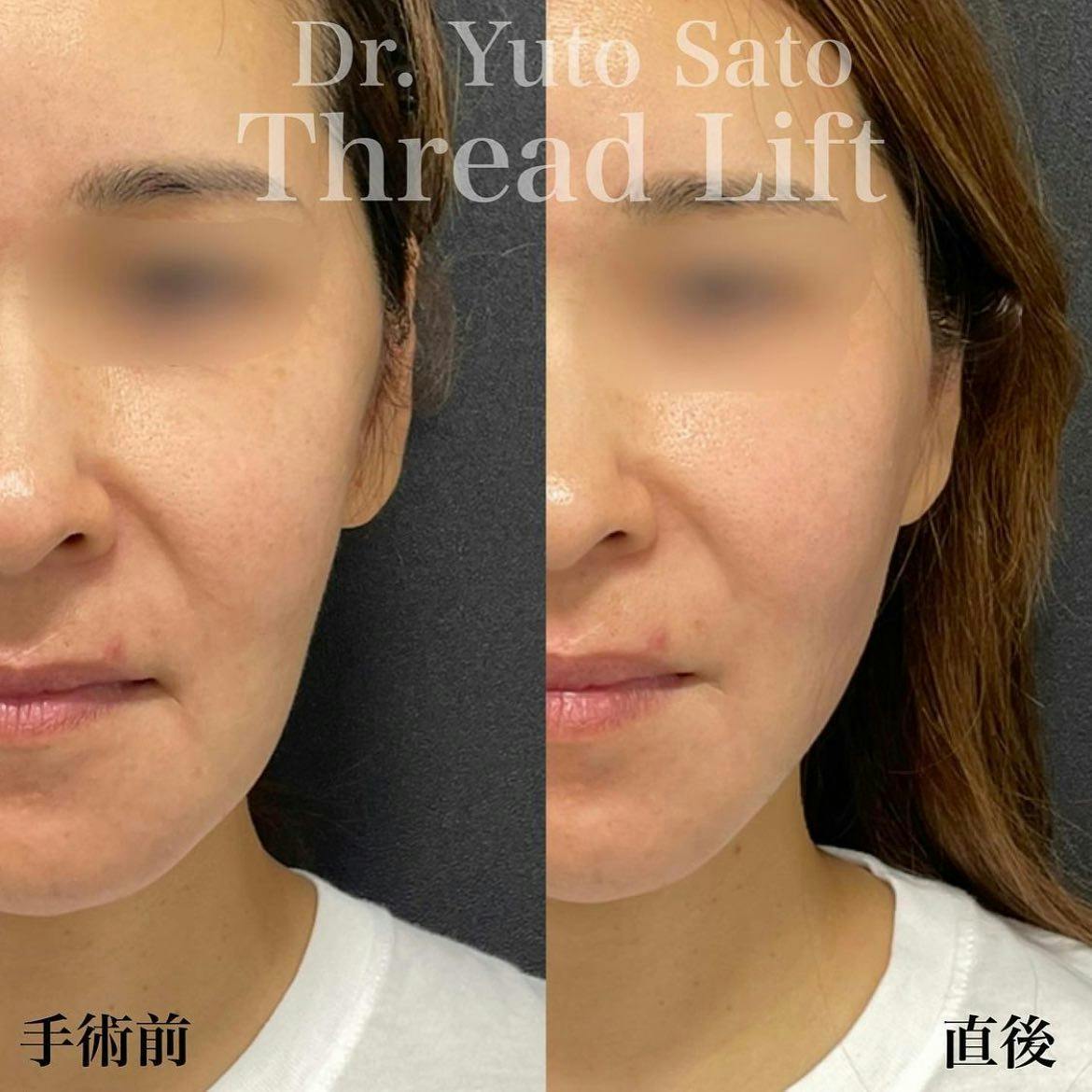 【女性・輪郭】糸リフト HIFU ボトックス_before_aftar