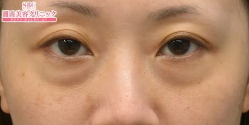 【30代女性・目元】目の下の切らないクマ・たるみ（ふくらみ）取り ナチュラル脂肪注射コンデンスリッチ ナチュラル脂肪注射ナノリッチ_before