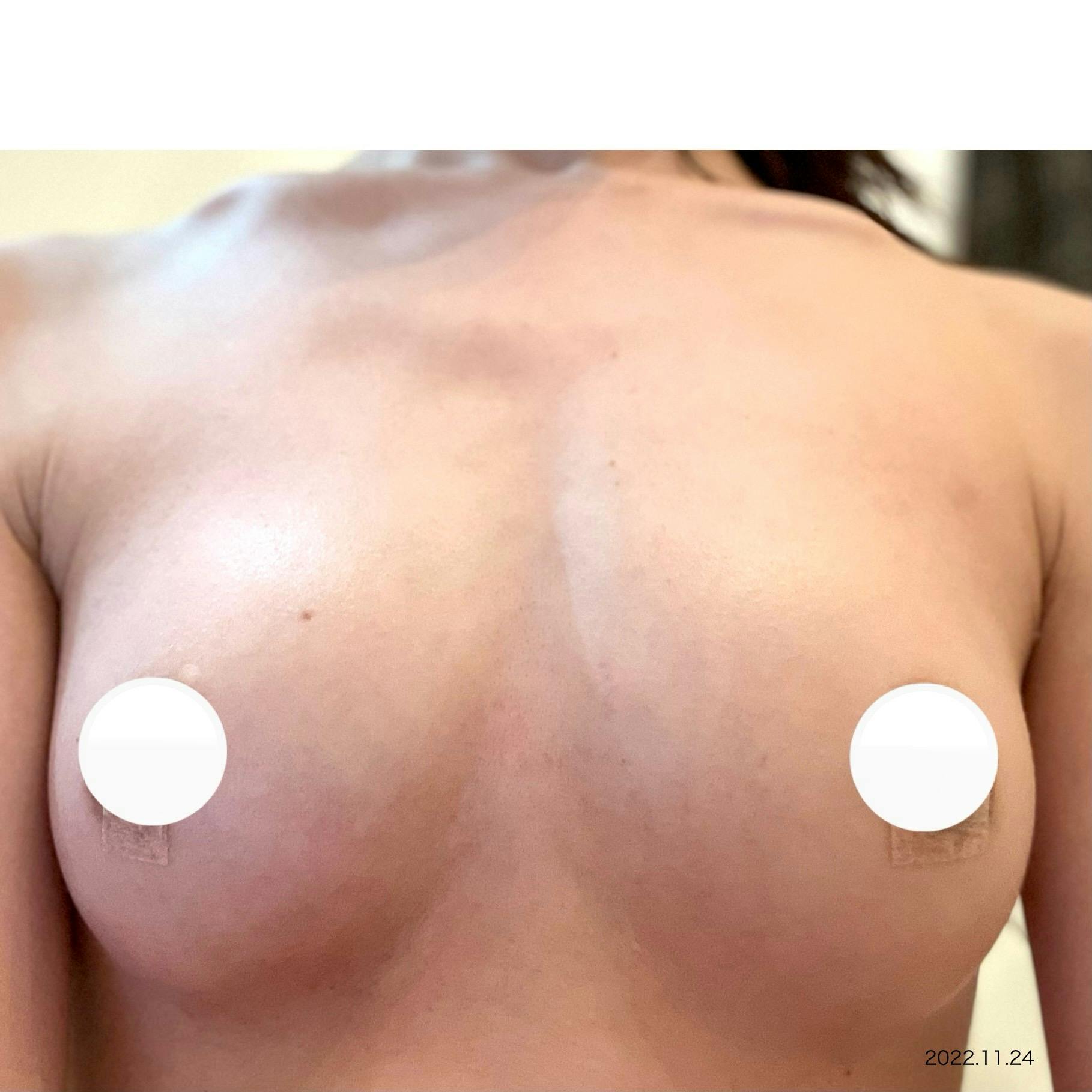 メットビューティークリニック(MET BEAUTY CLINIC)でMET式コンデンス豊胸を受けたarai03さんの写真