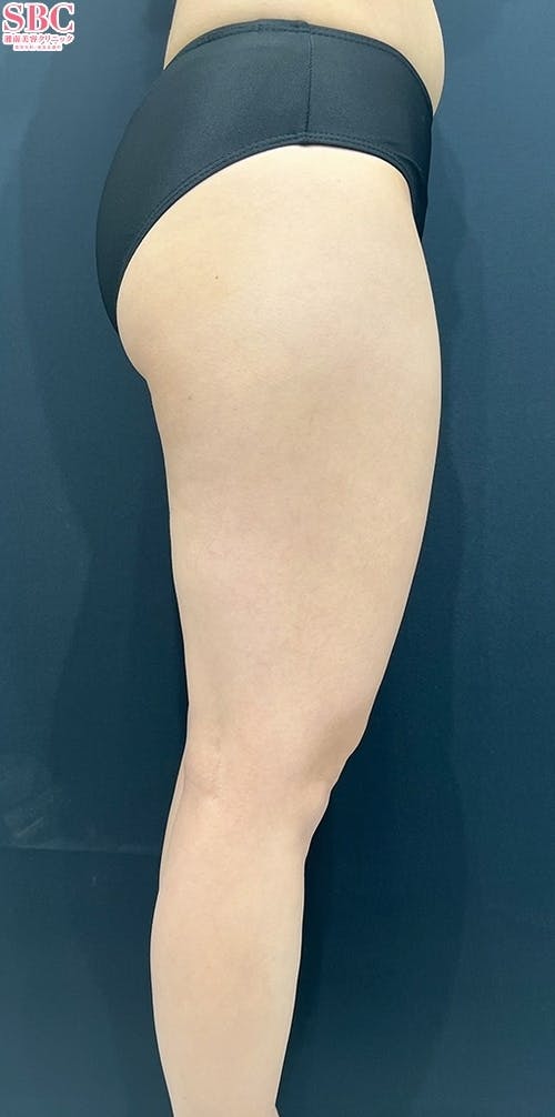 【20代女性・下半身】根こそぎVASER脂肪吸引_before