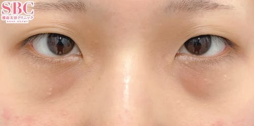 【女性・クマ】目の下の切らないクマ・たるみ（ふくらみ）取り、ナチュラル脂肪注射ナノリッチ、ナチュラル脂肪注射コンデンスリッチ_before