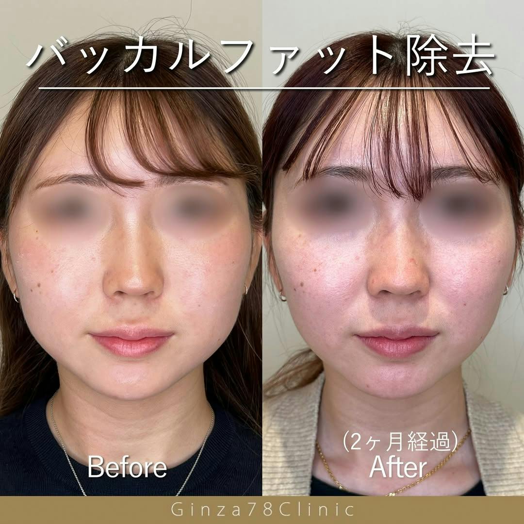 【女性・小顔】バッカルファット除去_before_aftar