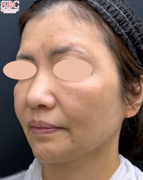 【女性・たるみ】メーラーファット除去術_before