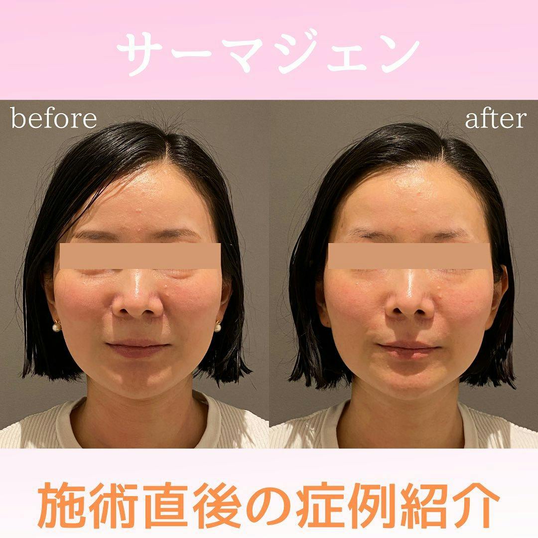 【女性・ほうれい線】サーマジェン_before_aftar