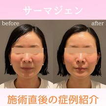 【女性・ほうれい線】サーマジェン_before_aftar