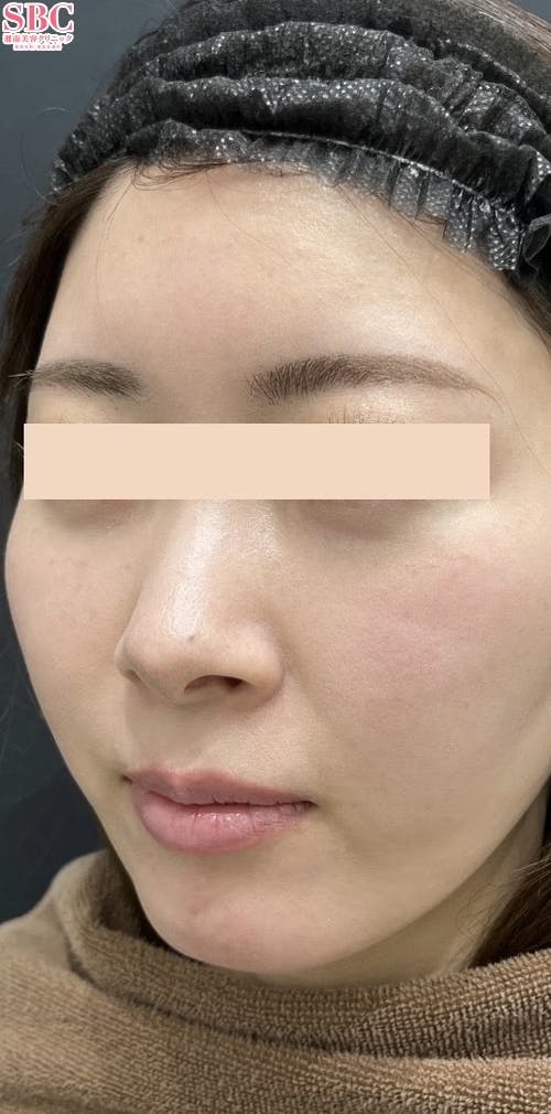 【女性・顎】ヒアルロン酸ジュビダームビスタ バイクロスシリーズ_before