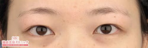 【女性・目元】眉下リフト（眉下切開）_before
