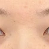 【女性・目元】眉下リフト(眉下切開)_before