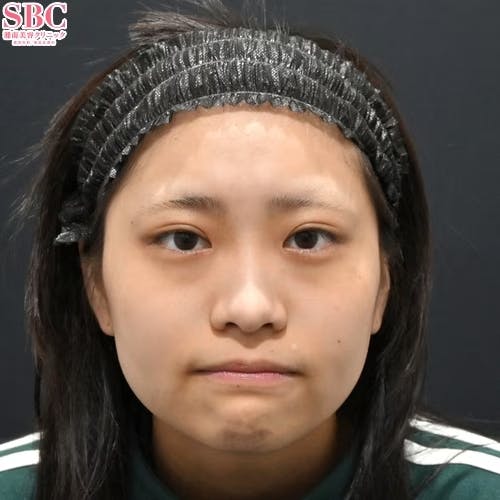 【20代女性・クマ】目の下の切らないクマ・たるみ（ふくらみ）取り ナチュラル脂肪注射コンデンスリッチ ナチュラル脂肪注射ナノリッチ_before