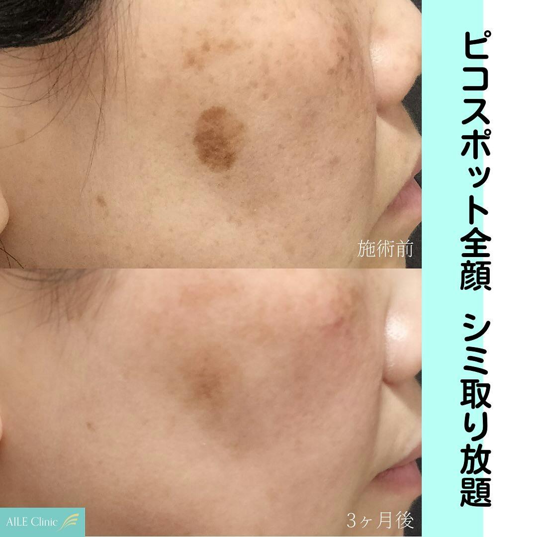 【女性・シミ】ピコスポット全顔_before_aftar
