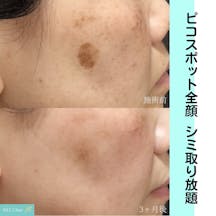 【女性・シミ】ピコスポット全顔_before_aftar