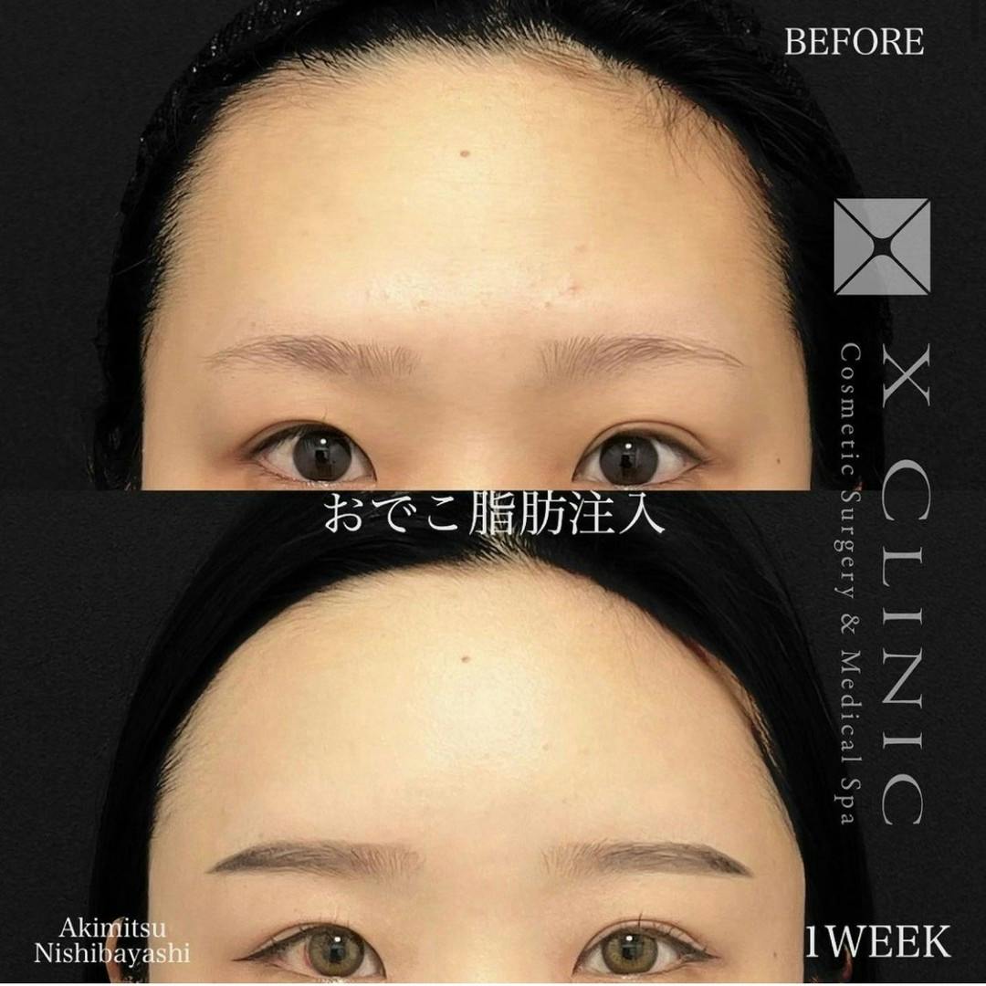 【女性・額】コンデンスリッチファット_before_aftar