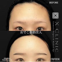 【女性・額】コンデンスリッチファット_before_aftar