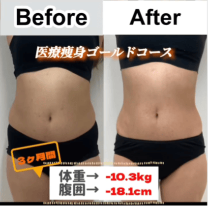 【女性・腹部】医療痩身ゴールドコース_before_aftar